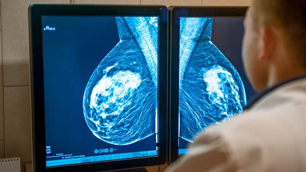 Diagnostic mammography uses lower-energy x-rays than screening mammography.