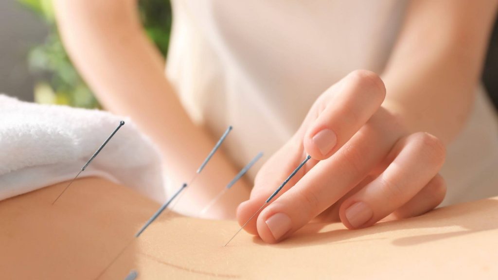 Acupuncture