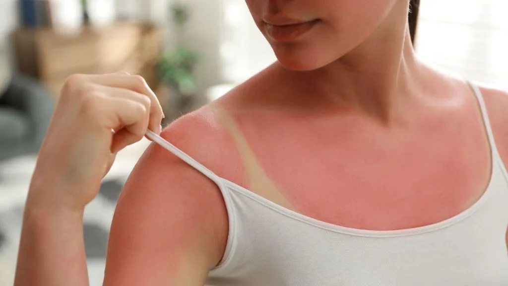 treat sunburn at home