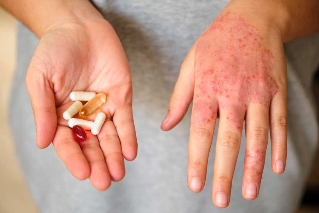 Comparing outdated vs. modern eczema treatment options