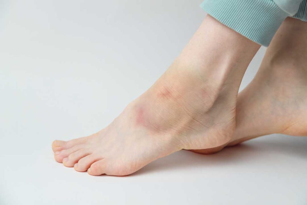 Swollen ankle indicating possible fracture.