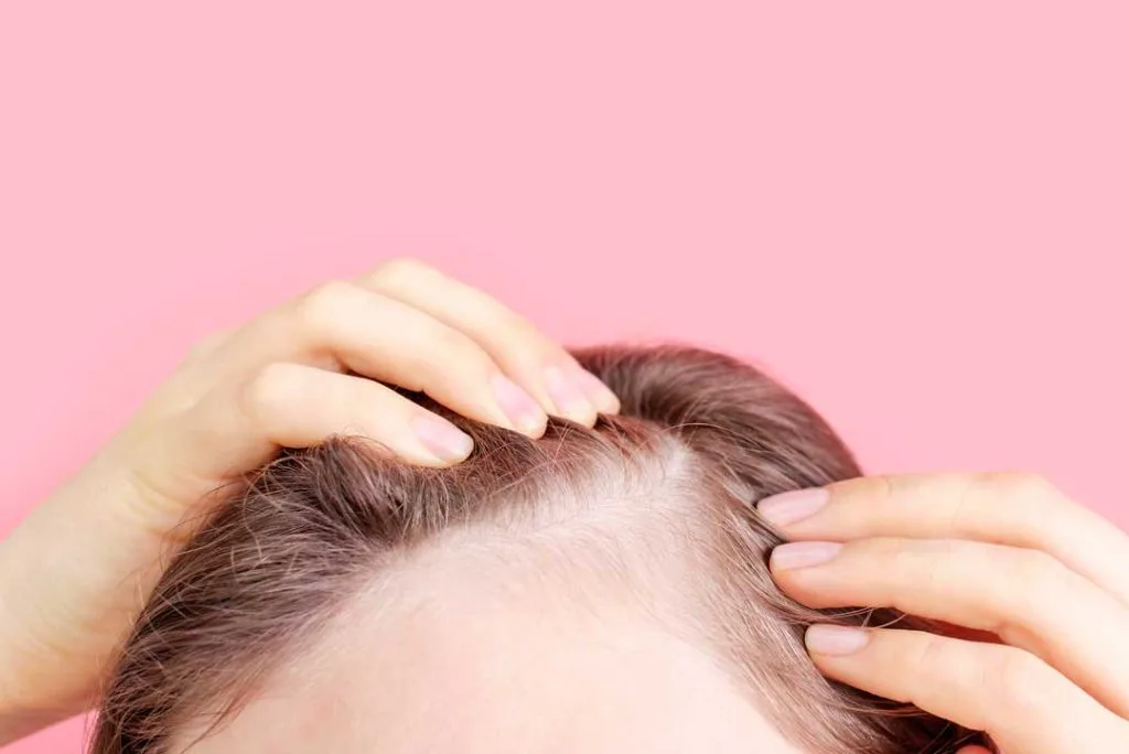 Medical diagram of scalp with labeled conditions