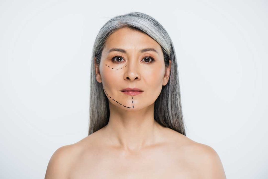 facelift consultation
