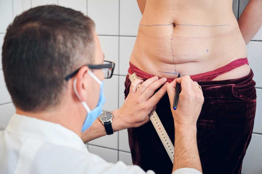 gastric bypass