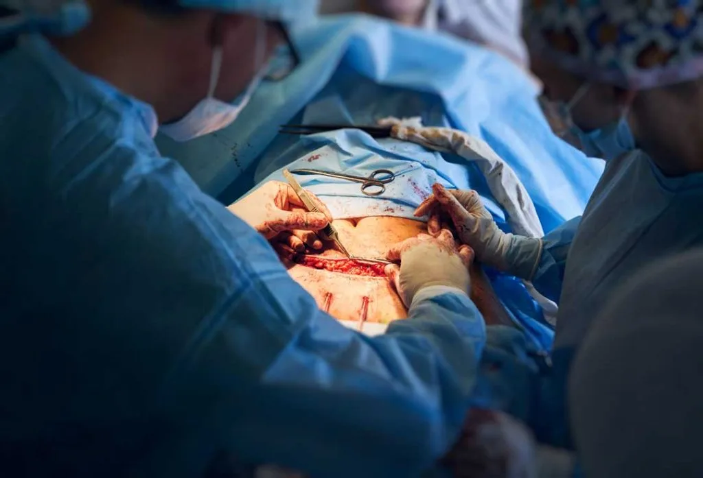 after c section