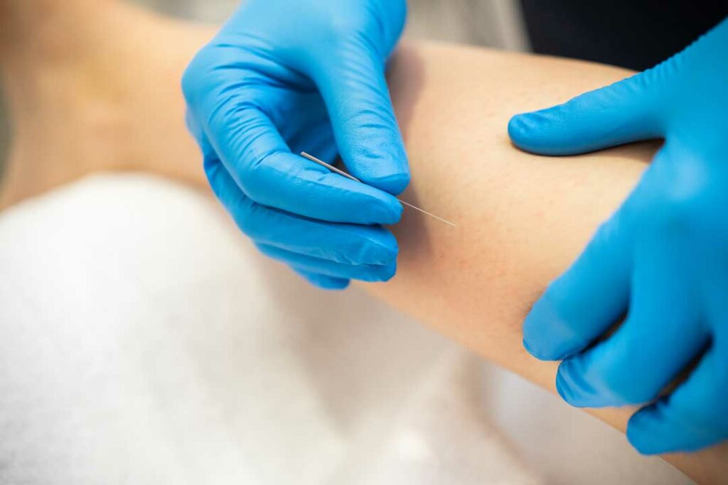 dry needling benefits