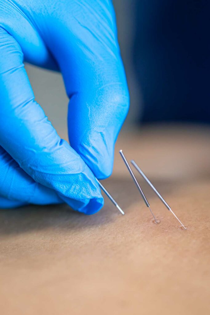 how dry needling works