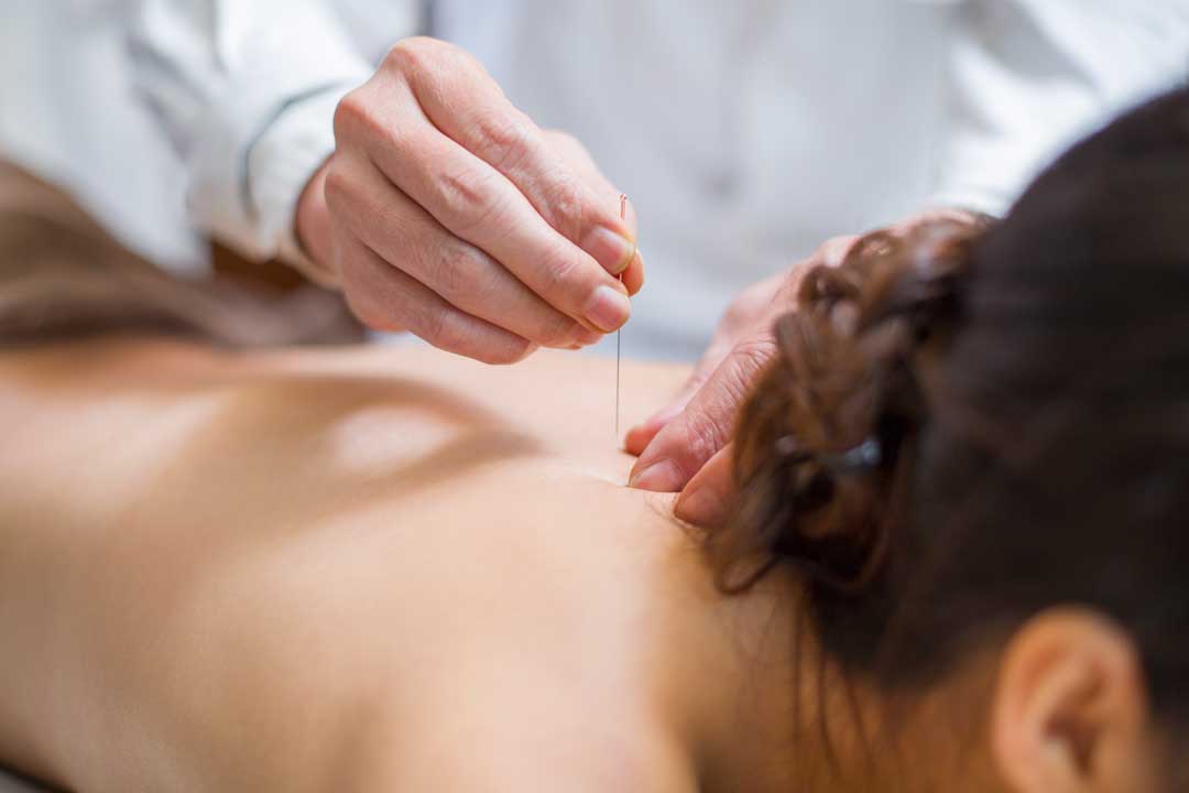 muscle recovery through dry needling